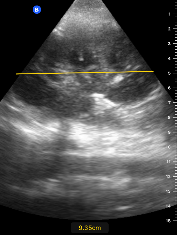 Renal — Ultra Sono